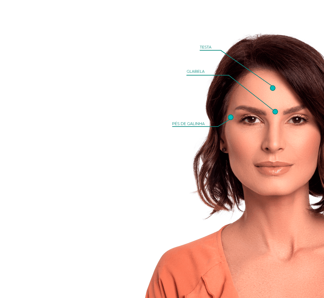 Imagem mostrando os pontos de aplicação de botox no rosto de uma mulher