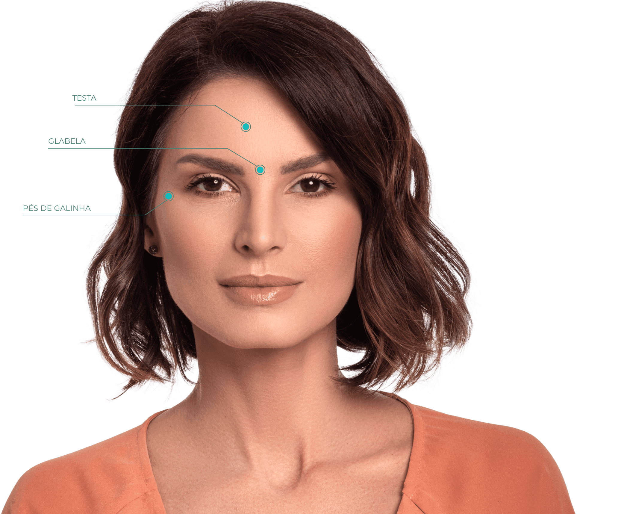 Imagem mostrando os pontos de aplicação de botox no rosto de uma mulher