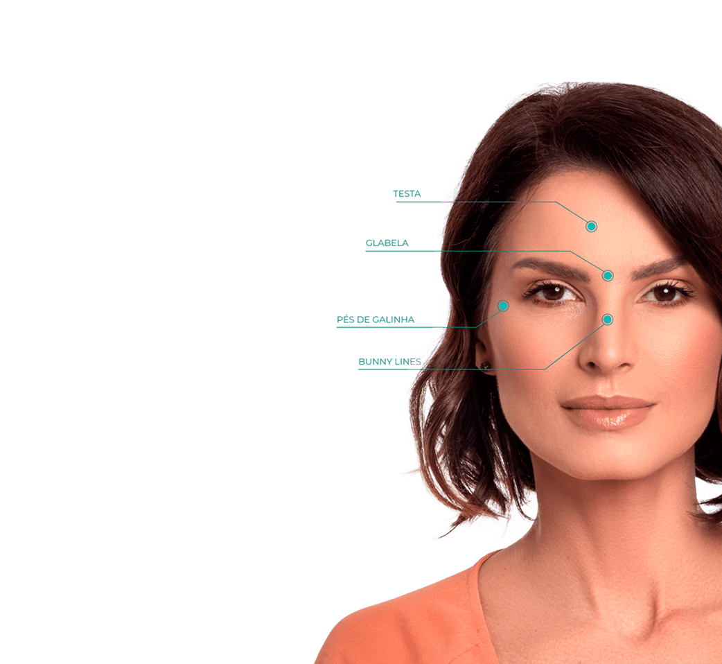 Imagem mostrando os pontos de aplicação de botox no rosto de uma mulher