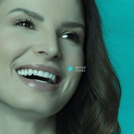 Preenchimento de Bigode Chinês com ácido hialurônico (Restylane 2ml)