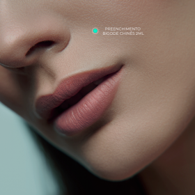 Preenchimento de Bigode Chinês com ácido hialurônico (Restylane 2ml)