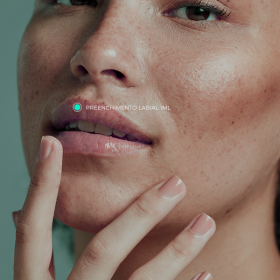 Preenchimento Labial com ácido hialurônico (Restylane Kysse 1ml)