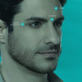 Toxina Botulínica 3 regiões pelo preço de 1 (testa + glabela + lateral dos olhos) - Aplicação Avulsa (c/ retorno)