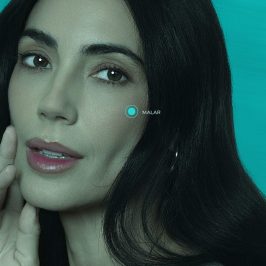 Preenchimento Malar com Ácido Hialurônico (Restylane Lift 1ml)