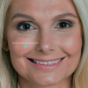 Preenchimento Malar com Ácido Hialurônico (Restylane Lift 1ml)